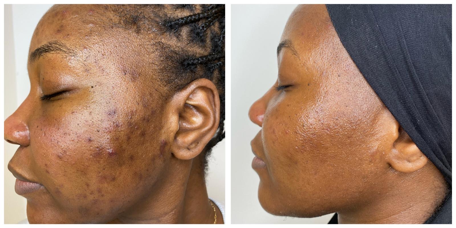 Voor en na een kuur acné peels: minder actieve acné en egalere huid