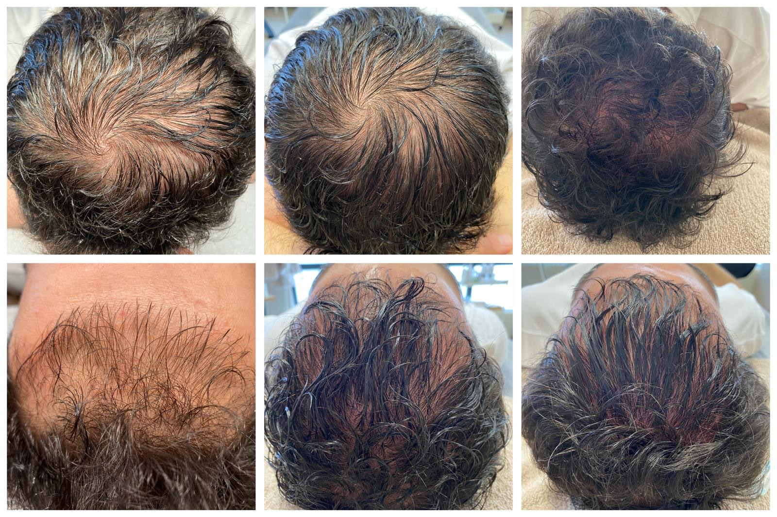 Voor en na hair loss microneedling: zichtbaar dichtere haargroei op de kruin