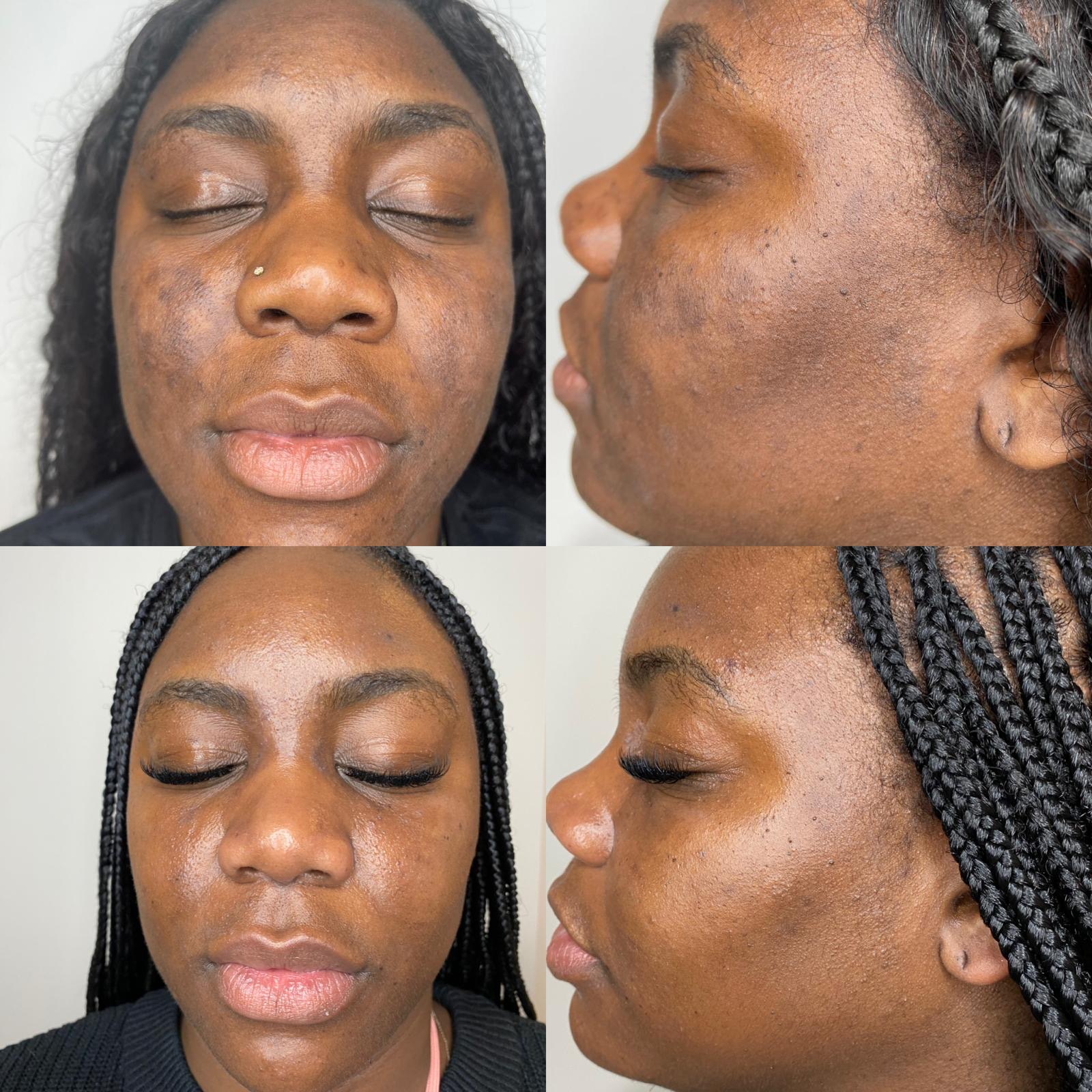Voor en na een pigmentatiepeel: vervaagde hyperpigmentatie en egalere teint