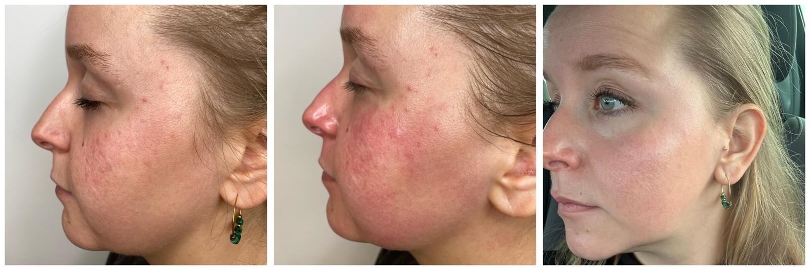 Voor en na een rosacea-behandeling: minder roodheid en rustiger huidbeeld